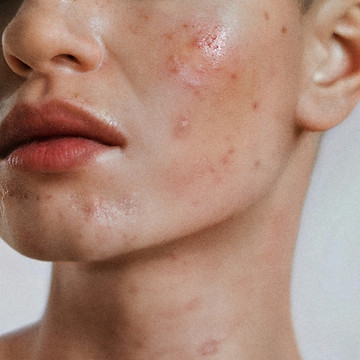 Skin care image representing acne treatment support