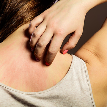 Allergic reaction image representing eczema and chronic skin support