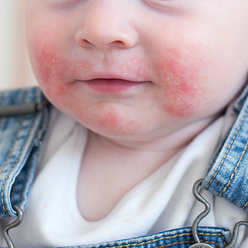 Worried child image representing fungal skin treatment support