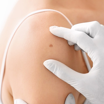 Skin biopsy image representing wart treatment support